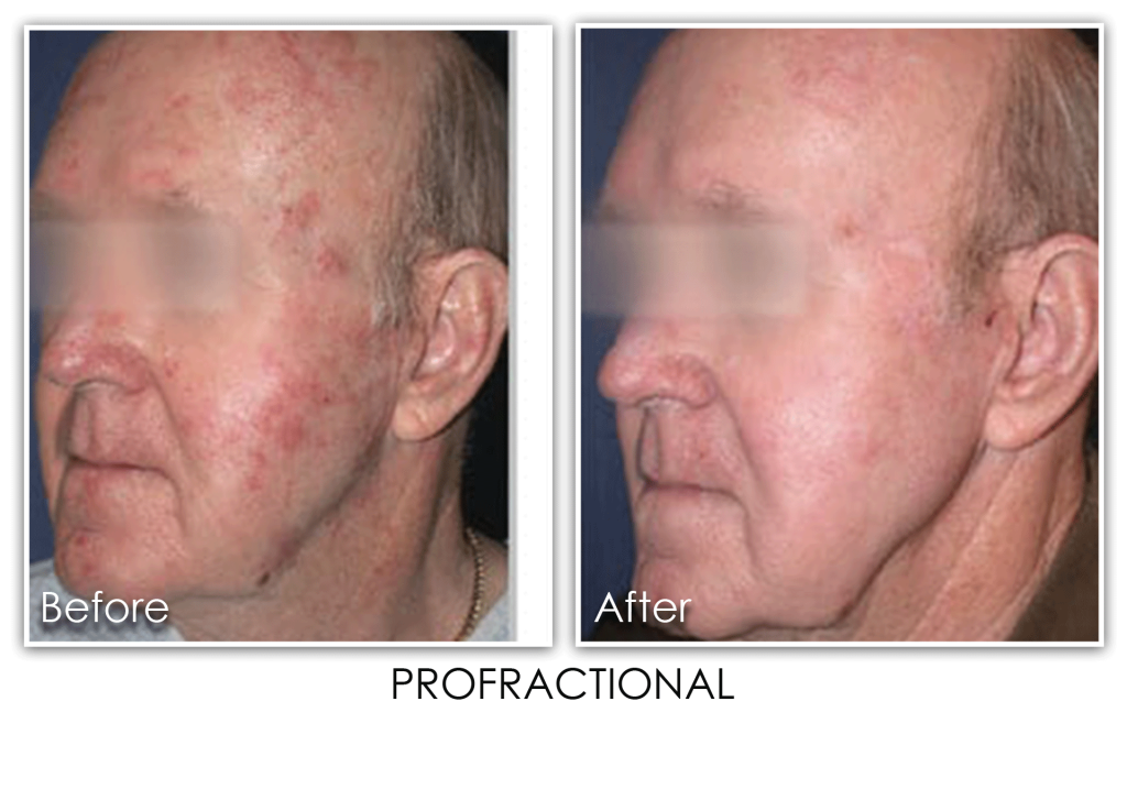 Profractional Laser For Men Archives Skin Rejuvenation Clinic Skin