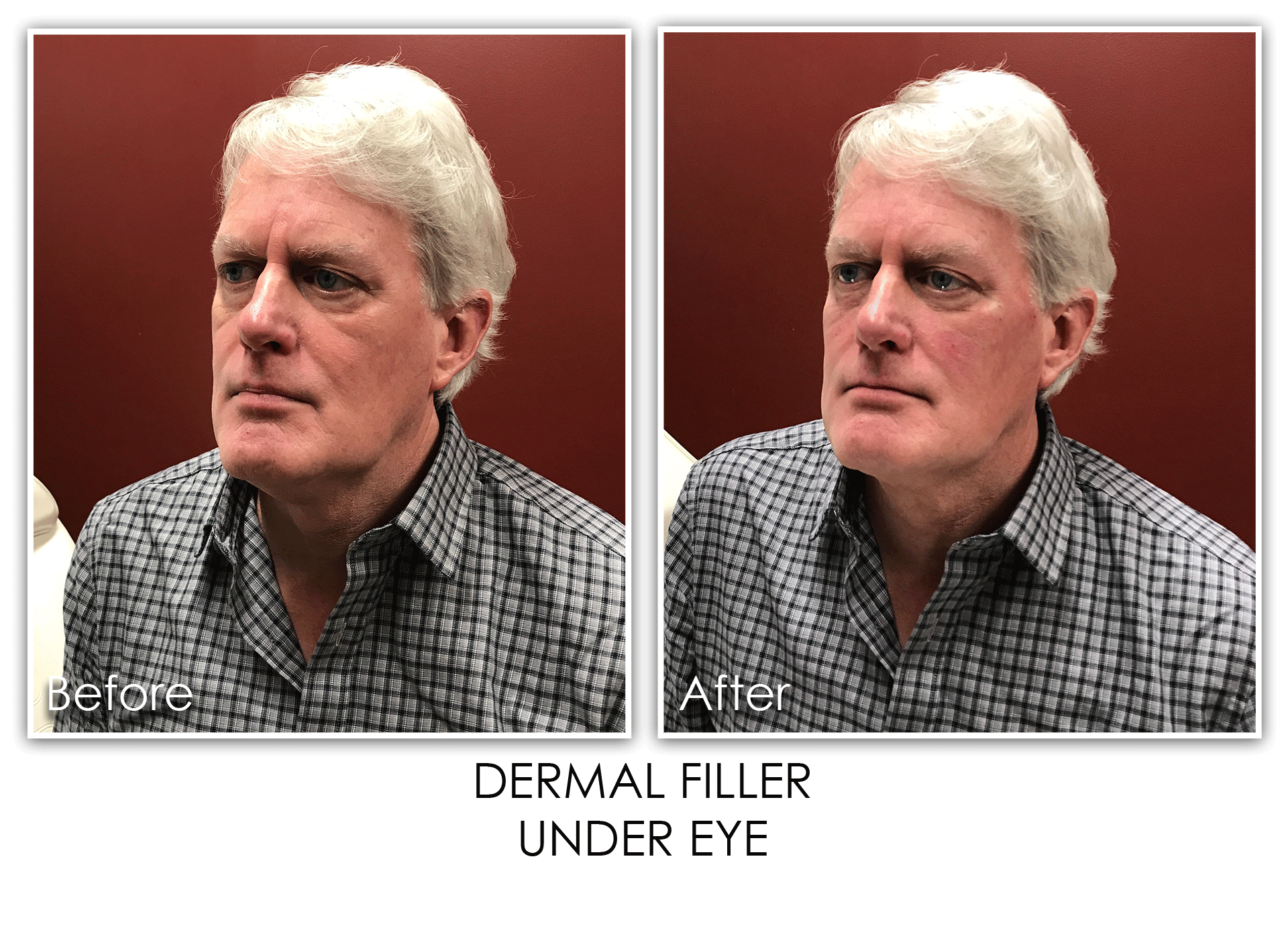 1-dermal-filler-under-eye-skin-rejuvenation-clinic-skin-rejuvenation