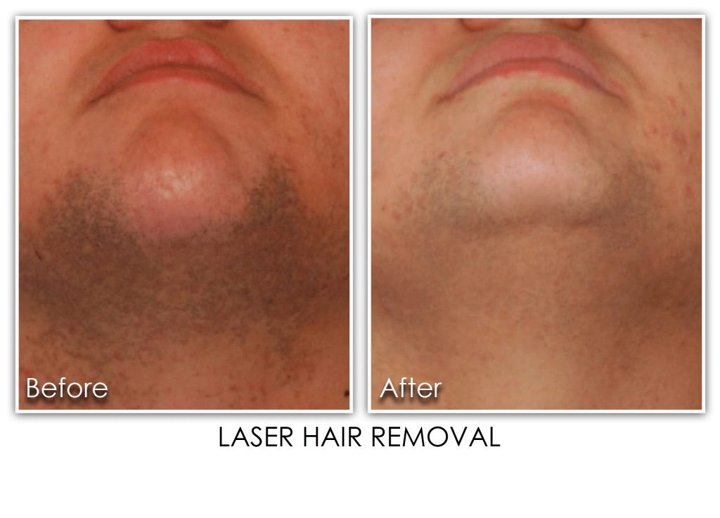 Laser Hair Removal For Men Archives Skin Rejuvenation Clinic Skin Rejuvenation Clinic 