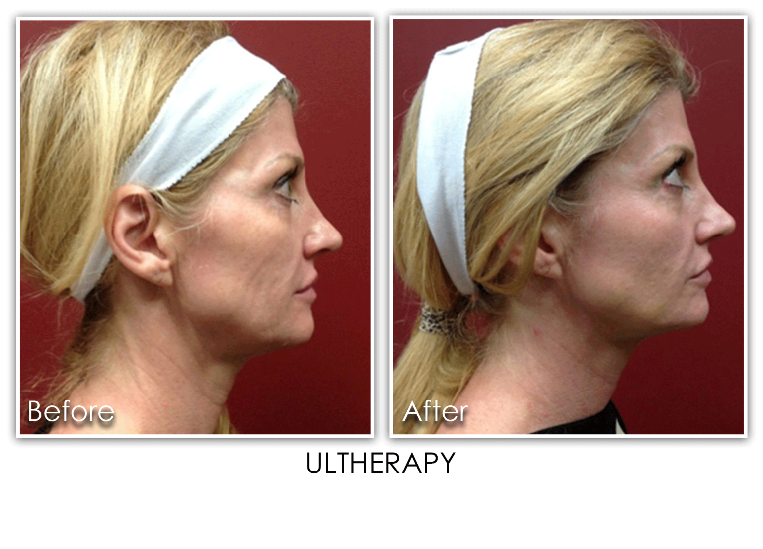 Ultherapy Archives - Skin Rejuvenation Clinic Skin Rejuvenation Clinic