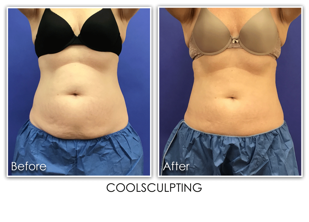 Coolsculpting Pro Archives Page 2 Of 3 Skin Rejuvenation Clinic Skin Rejuvenation Clinic 