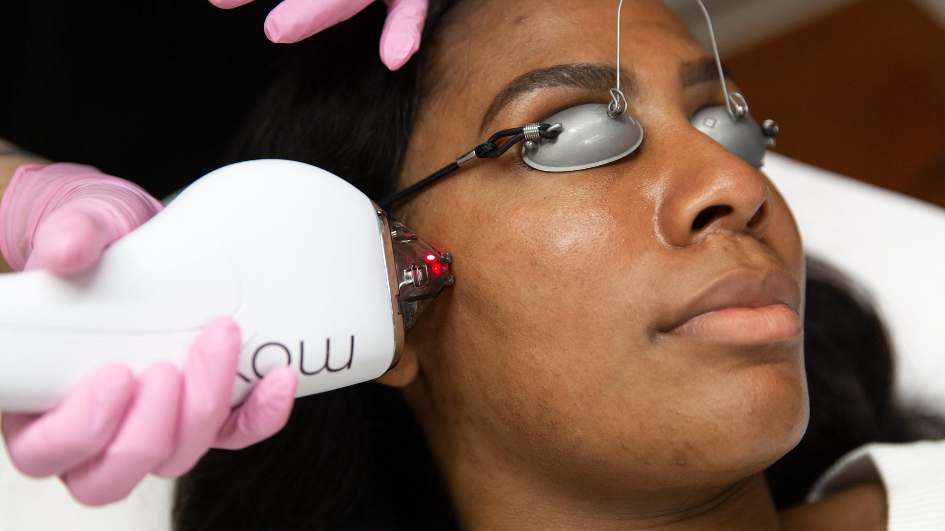 How Moxi Laser Works and Why You Should Consider It! - Skin ...